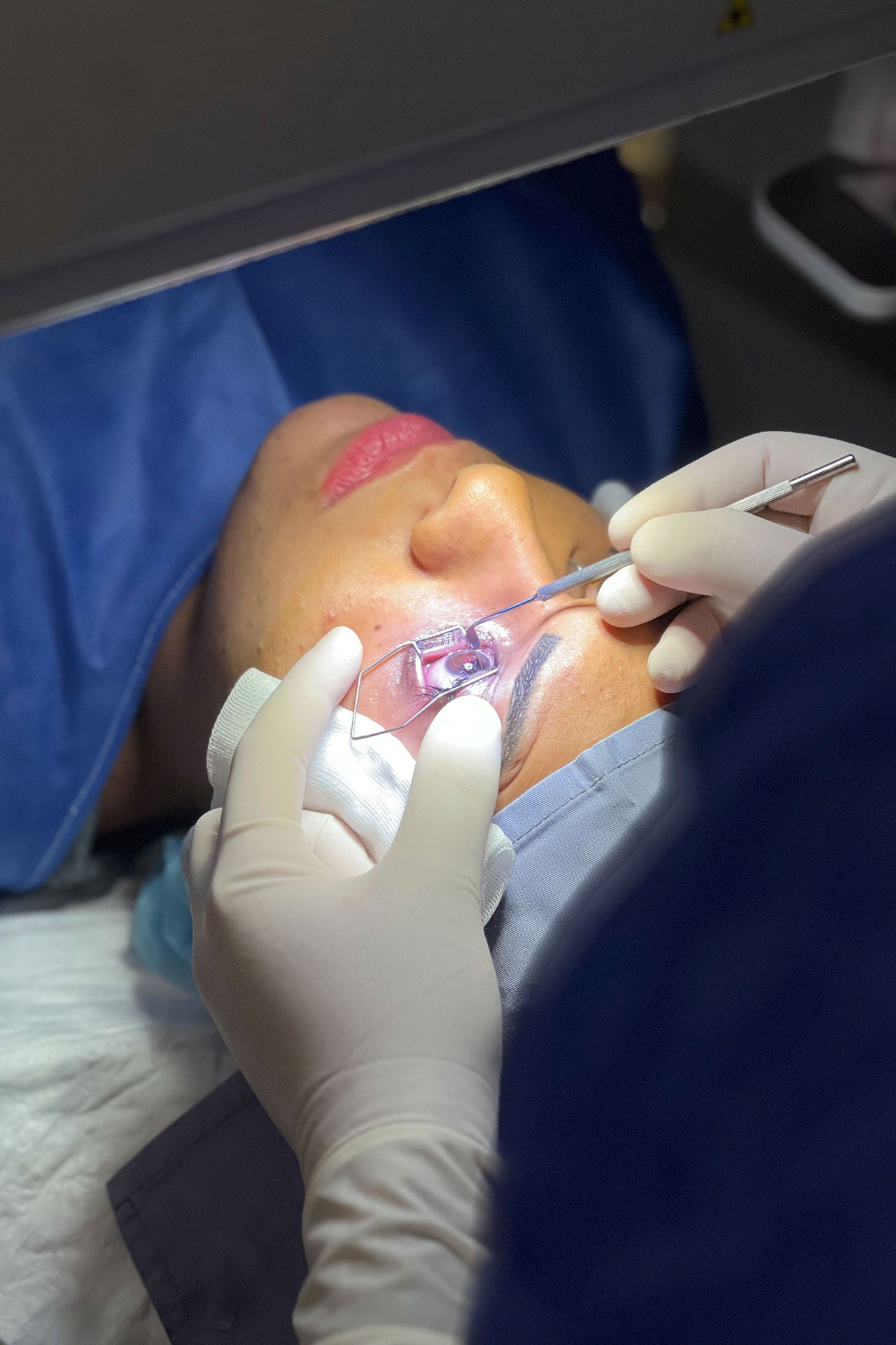 Ophthalmologist performing laser eye surgery with surgical tools on a patient’s cornea.